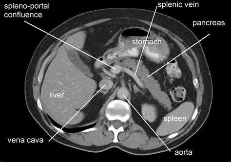 Ct Anatomy Of Pancreatic Level Ct Scan Tips And Protocols