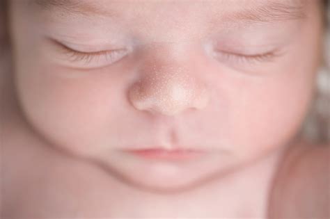 Milk Rash Vs Baby Acne Vs Milk Spots Identify Your Babys Condition