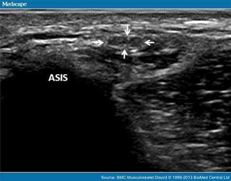 Ultrasound Of The Lateral Femoral Cutaneous Nerve In Adults Images