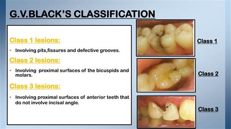 Gv Black Classification Of Dental Caries Dental Caries Dental Porn
