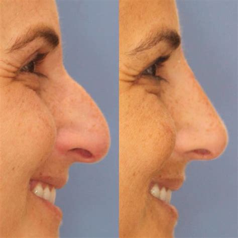 Dr Pham Cosmetic Surgery Of Nose Perth Before And After Rhinoplasty Cost Pics Reviews Qanda