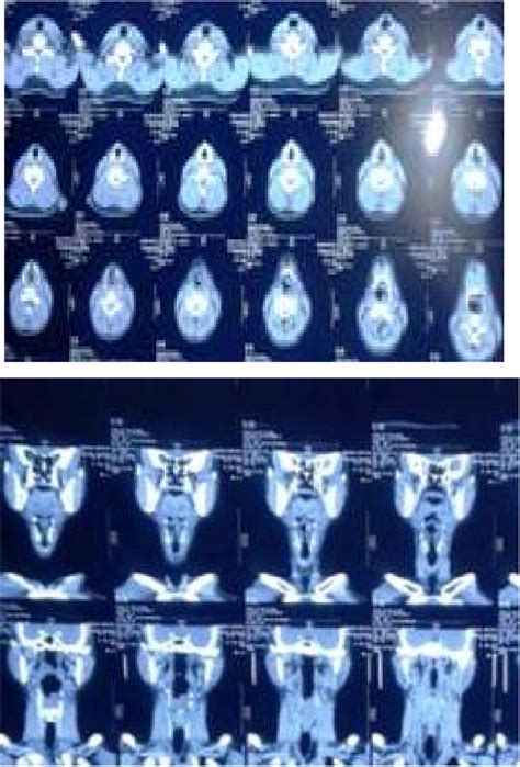 Computed Tomography Ct Scan Showing Mass Download Scientific Diagram