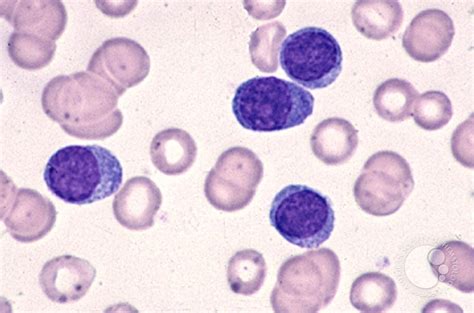 Plasma Cell Leukemia 2
