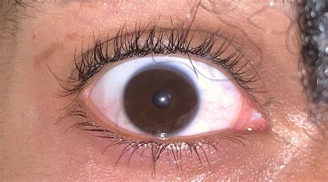 i have this blue ring around my eye i m 16 with an average weight about 135 140 is this a sign