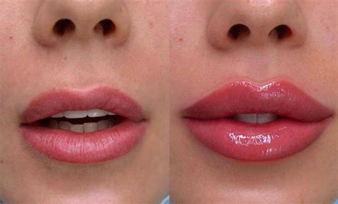 Russian Lip Filler Technique Before And After Before And After