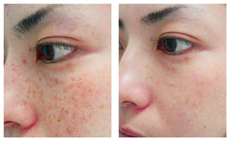 Quinnipiac University Transfer Laser Treatment For Freckles