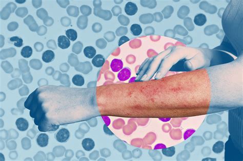What A Leukemia Rash Is Symptoms And How To Treat It