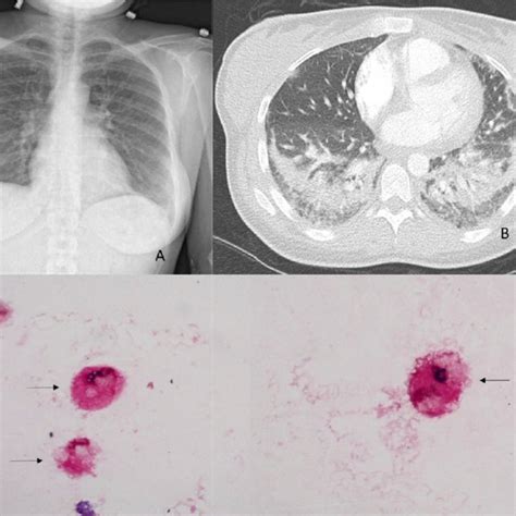 A Chest X Ray Bilateral Lower Lobe Patchy Infiltrates B Chest Ct
