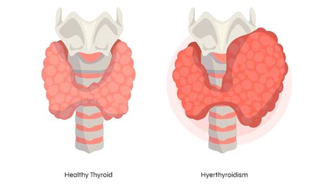 Hyperthyroidism Symptoms Causes Diagnosis And Treatment