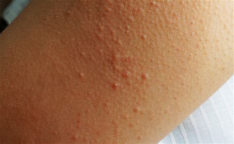 Keratosis Pilaris Chicken Skin Medical Secrets