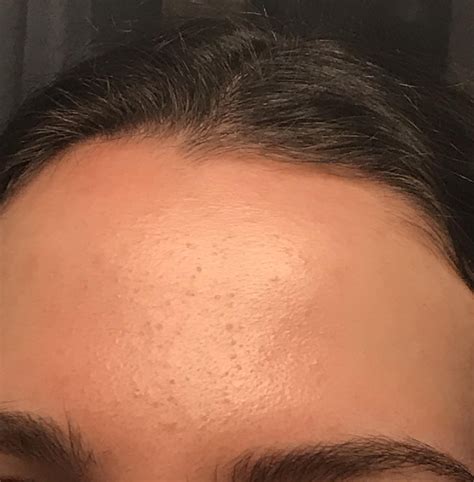Skin Concerns Tiny Bumps On Forehead Keep Coming Back Not Sure What The Cause Is Does Anyone
