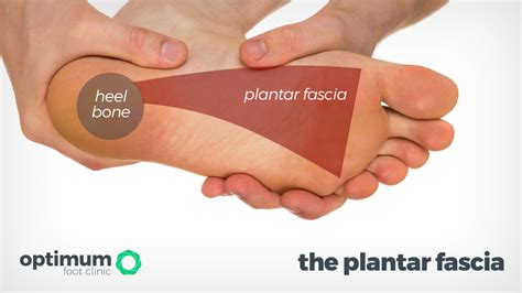 Plantar Fasciitis Heel Pain Explained Optimum Foot Clinic