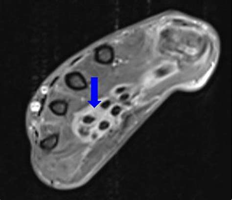 Figure 2 From A Case Of Paraneoplastic Remitting Seronegative