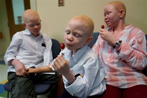 Tanzanian Albino Children Whose Limbs Were Hacked Off For Witchcraft