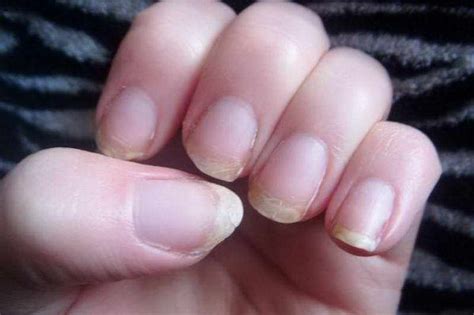 12 Changes In Your Fingernails That Could Signal Other Problems
