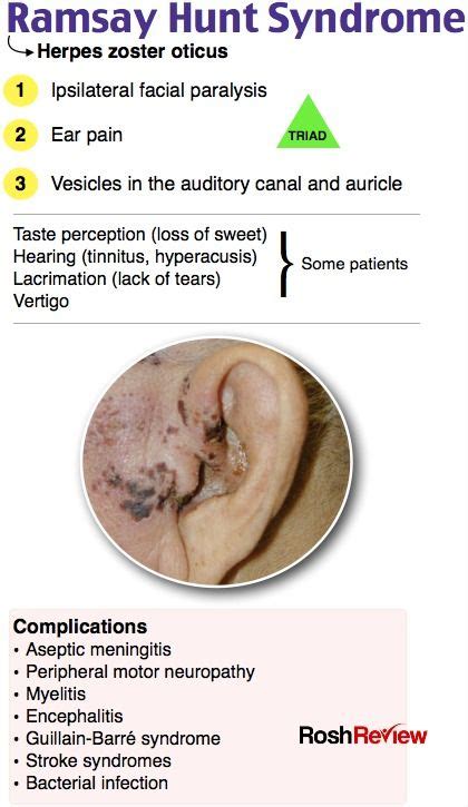 Ramsay Hunt Syndrome Rubenaddmcmillan