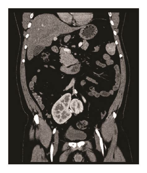 Axial A And Coronal B Ct Scan With Intravenous Contrast In The