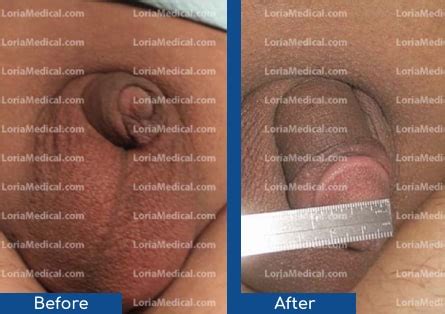 Penile Enlargement Surgery Nyc Cost From Loriamedicalcenter Com