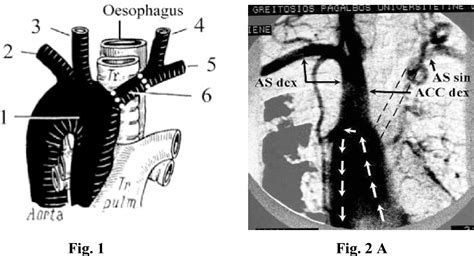 Figure 1 From The Right Aortic Arch With Mirror Image Branching Of