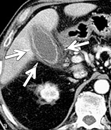 Acute Cholecystitis Preoperative Ct Can Help The Surgeon Consider