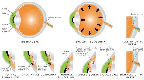Tips To Stop Glaucoma Progression New Jersey Eye Center