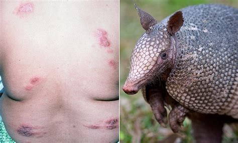 Nine Banded Armadillos Thought To Have Caused Leprosy In Florida