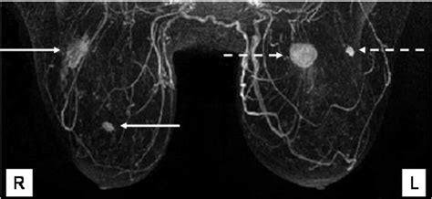 Breast Imaging The Bmj