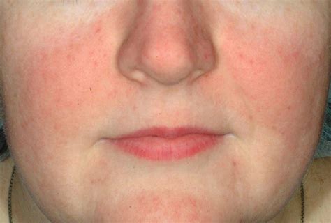 Rosacea Treatments Melbourne Facial Flushing