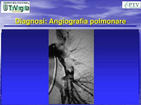 La scarsità di piastrine (piastrinopenia o trombocitopenia) può essere causata da diverse condizioni e patologie, le cui cause tipicamente ricadono in una di queste categorie PPT - EMBOLIA POLMONARE PowerPoint Presentation, free ...
