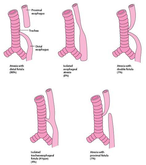 Table Types And Relative Frequencies Of Esophageal Atresia And