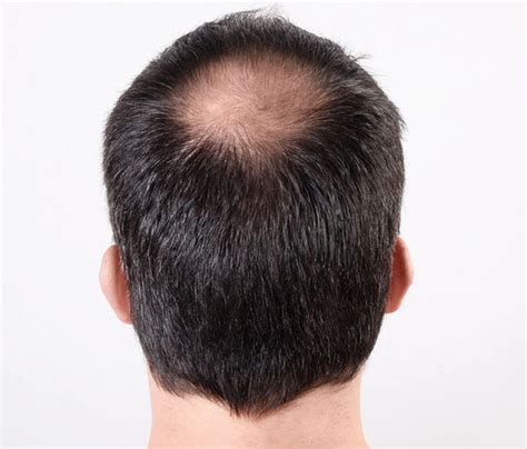 Unlike widespread hair loss, thinning hair doesn't necessarily cause baldness. Hair loss myth BUSTED: Will YOU have a bald head because ...