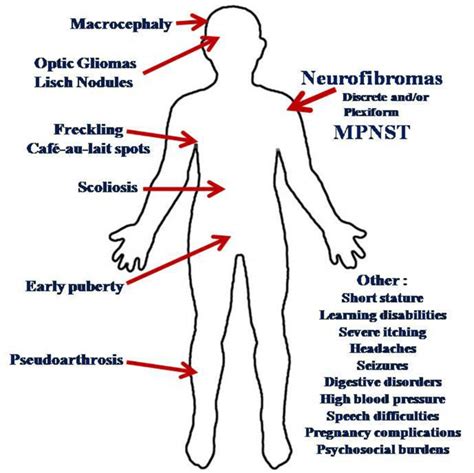 2 Nf1 Manifestations The Disease Neurofibromatosis Type 1 Nf1 Has