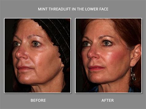 Mint Thread Lift Instant Non Surgical Facelift With Threads