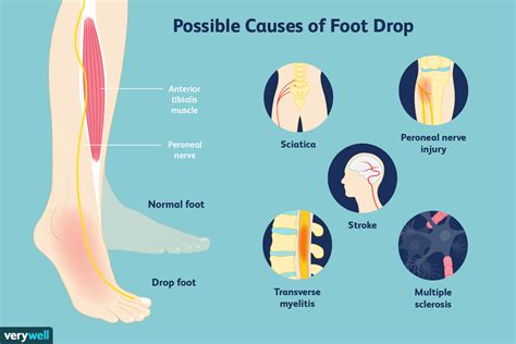 Fysiotherapie Oefeningen Voor Drop Foot Med Nl