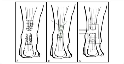 The achilles tendon, seen in this diagram, attaches to the back of the heel bone (calcaneus) about halfway between the top and bottom of the back of the heel bone. Schematic diagram illustrating each repair and their ...