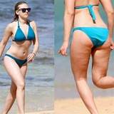 Celebrity Cellulite Treatment Pictures