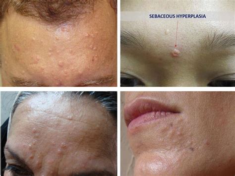 Dont Panic Its Only Sebaceous Hyperplasia No Body Problems Skin
