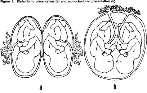 Figure 1 From Of Monozygotic Twins And Concordance For Schizophrenia