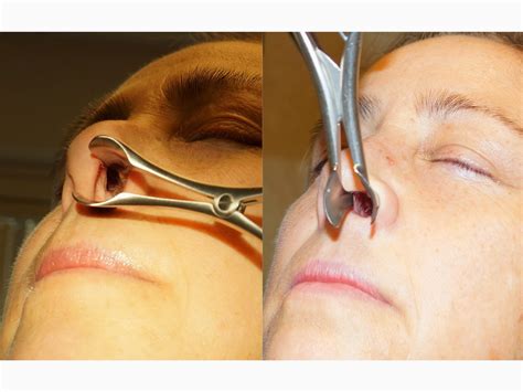 Facial Plastic Surgery Septal Perforation Repair Rhinoplasty Reconstructive Pollybeak