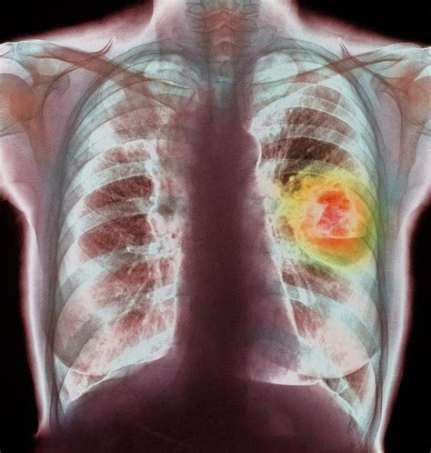 Coloured X Ray Showing Lung Cancer Photograph By Simon Fraserscience
