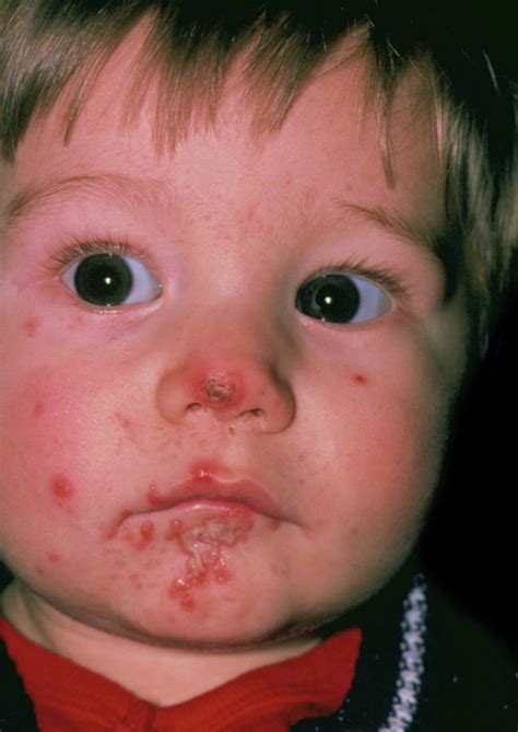 Impetigo Sores On The Chin Of An Infant Photograph By Dr P Marazzi