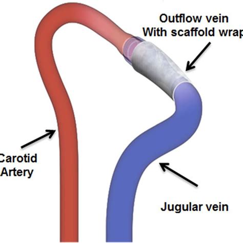 Schematic Representation Of An Arteriovenous Fistula Between The