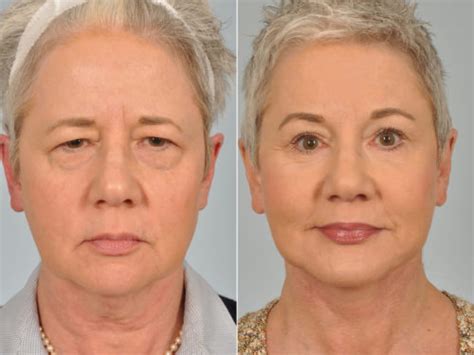 Facelift And Necklift Surgery Photos Plymouth Pennsylvania Patient