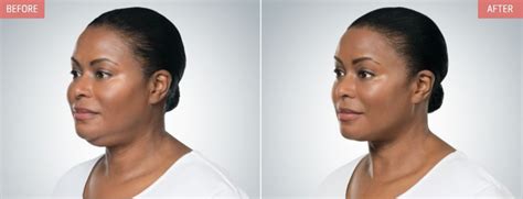 Kybella For Double Chin Atlanta Buckhead Medspa Treatments