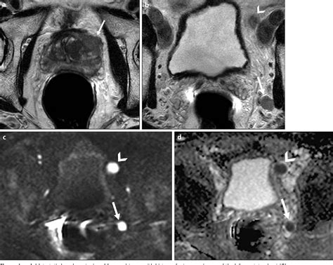 Figure 2 From Local Staging Of Prostate Cancer With Mri Semantic Scholar