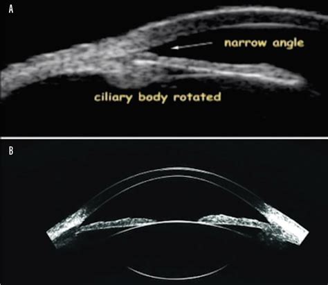 Imaging The Outflow System Glaucoma Today