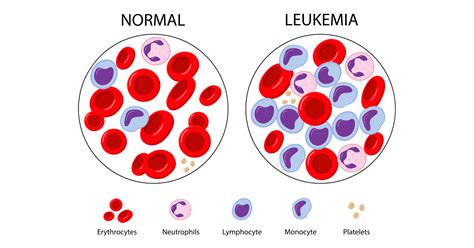 Leukaemia Cancer Symptoms Causes Prevention And Treatments