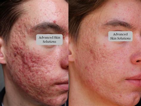 Acne Advanced Skin Solutions
