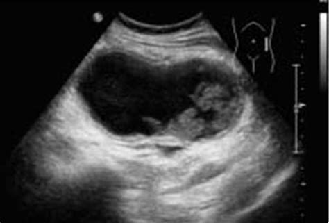 Ultrasound Abdomen Showing A Abdominal Large Cystic Mass Download