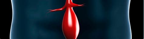 Abdominal aortic aneurysm (aaa or triple a) is a localized enlargement of the abdominal aorta such that the diameter is greater than 3 cm or more than 50% larger than normal. Aneurisma da aorta abdominal (AAA) - SBACV - Regional São ...